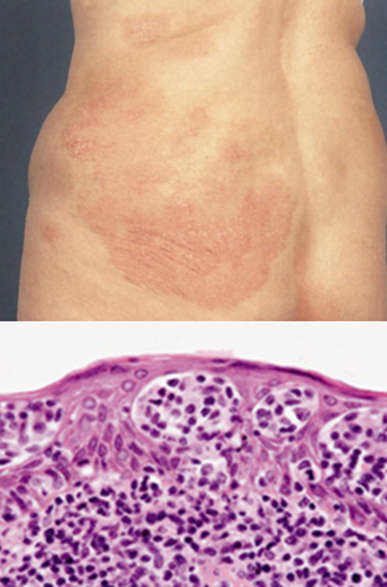 <p>Cutaneous T-cell lymphoma that can resemble eczematoid or psoriasis</p><p></p><p>Might have cerebriform nuclei <span>→</span> sezary syndrome</p>