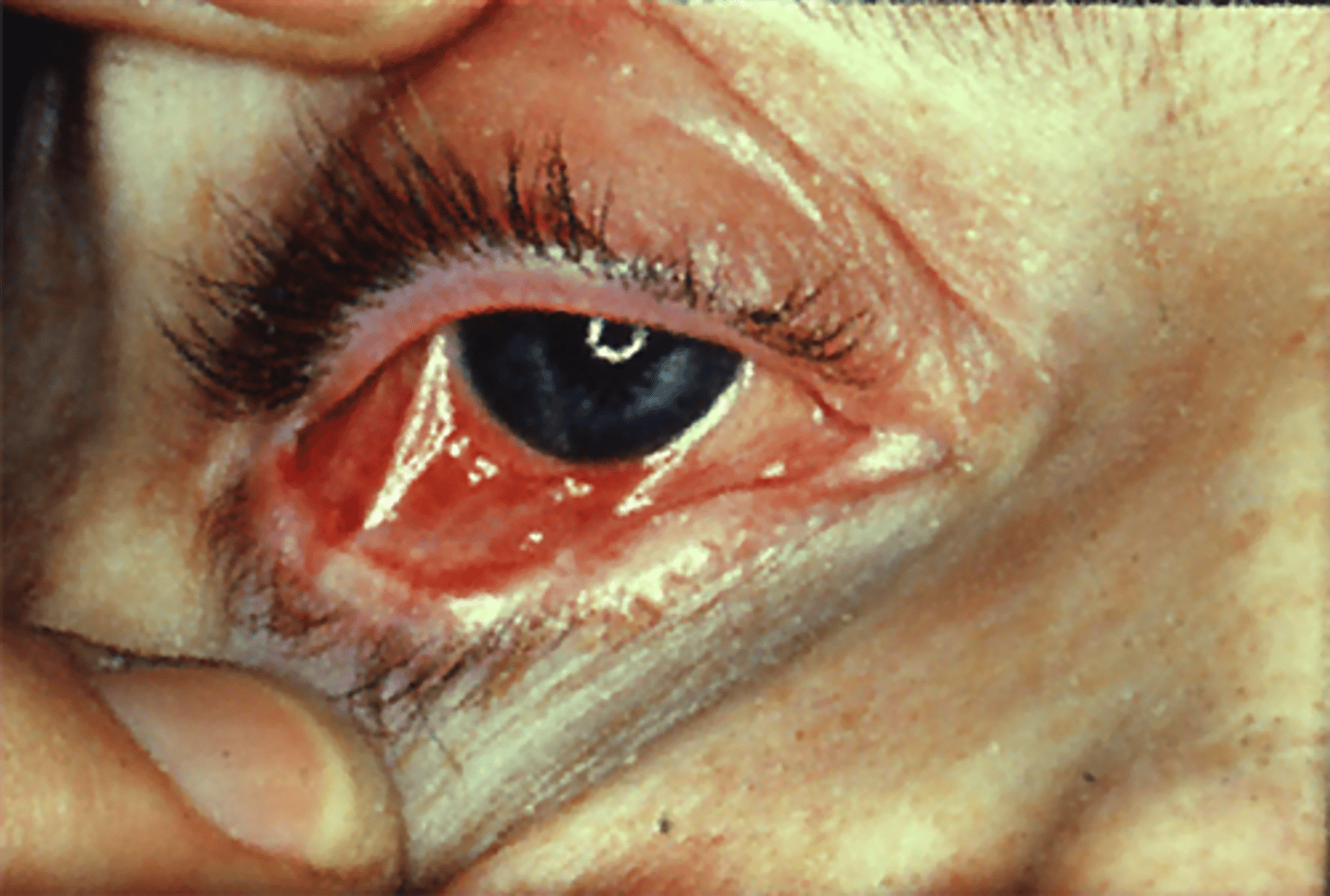 <p>conjunctival/corneal</p>