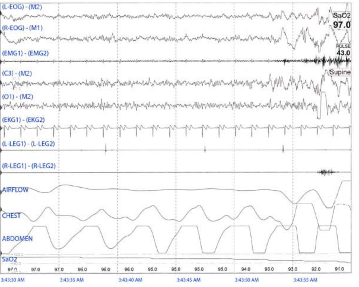 <p>The following 30 second epoch is observed during a sleep study of an adult. The patient will most likely require therapeutic intervention for</p>