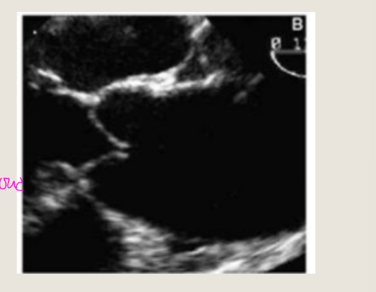 <p>Systemic hypertension is a</p><p>chronic condition that occurs</p><p>when blood pressure in the</p><p>arteries is too high. Aka high</p><p>blood pressure or hypertension</p><p>The aorta will experience</p><p>effacement of the ST junction</p><p>and dilatation of the ascending</p><p>aorta</p>