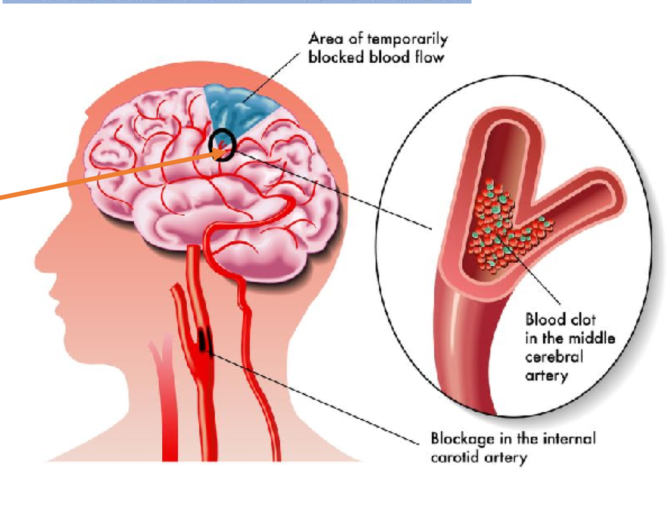<p>What is Cerebrovascular accident and what is it caused by?</p>