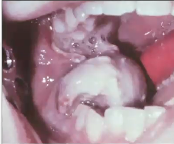<p>What are some clinical features of ewing sarcoma?</p>