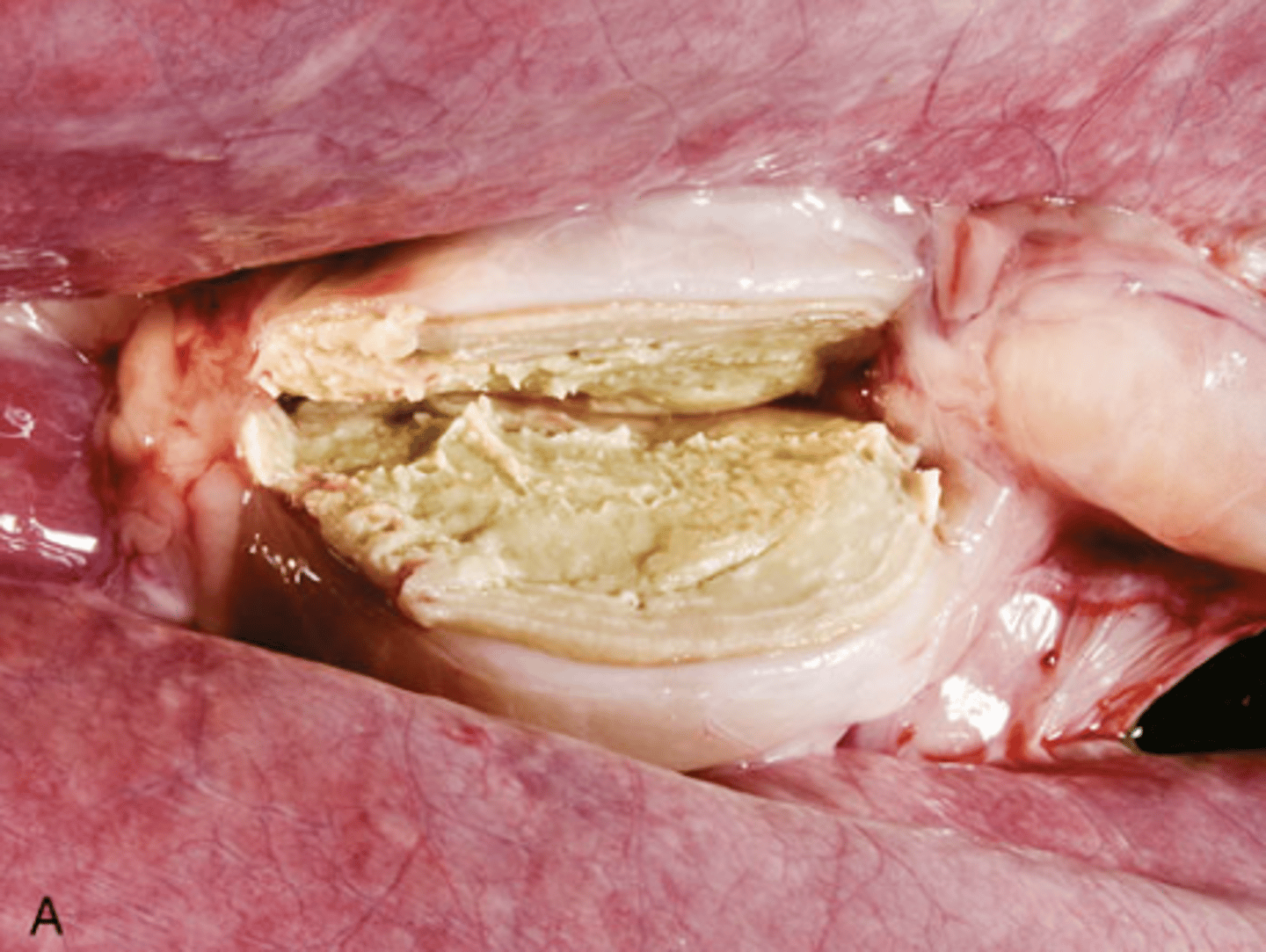<p>What type of necrosis is being shown in this image?</p>