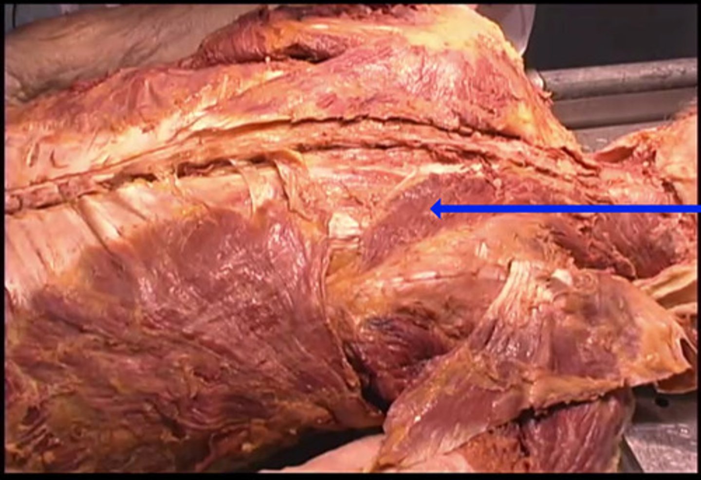 <p>What is the name of the muscle being shown here by the blue arrow?</p><p>teres major</p><p>deltoid</p><p>trapezius</p><p>rhomboid</p>