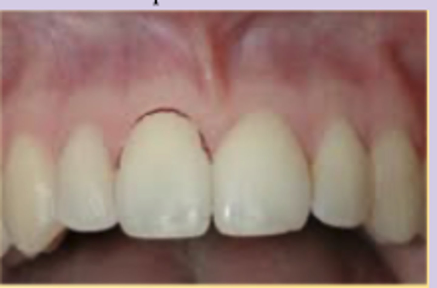 <p>injury to tooth-supporting structures with abnormal loosening, but without displacement clinically or radiographically</p>