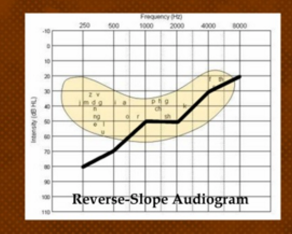 <p>hearing loss is worse and then rises to better</p>