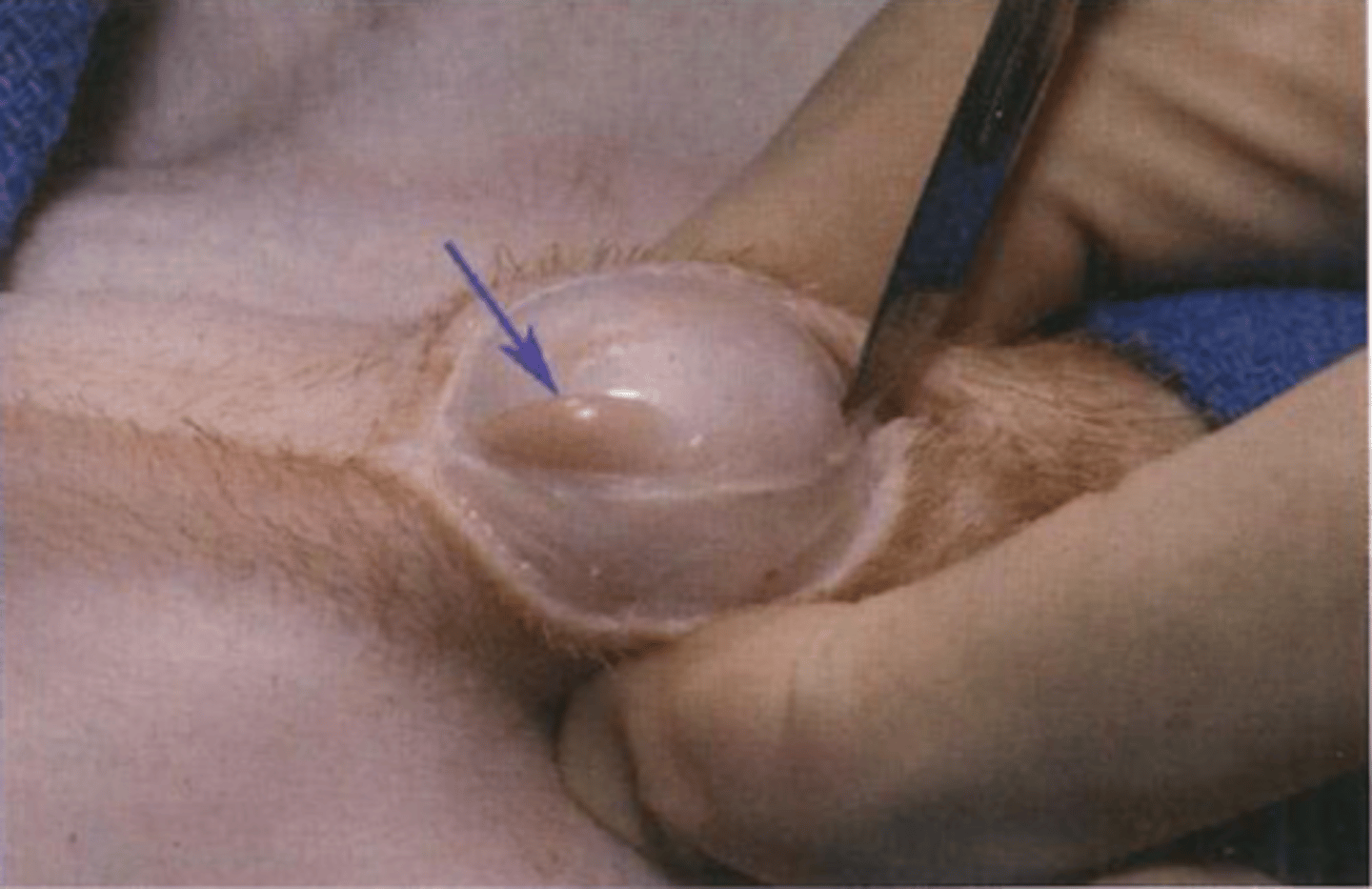 <p>closed castration can be used in any size dog as long as spermatic cord is...</p>