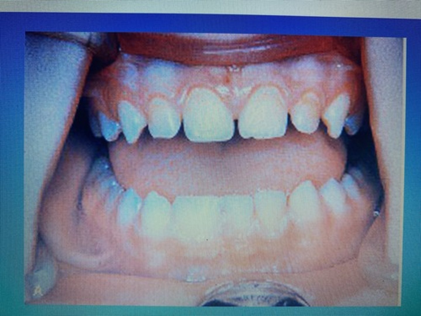 <p>Germination (this large tooth has one root)</p>