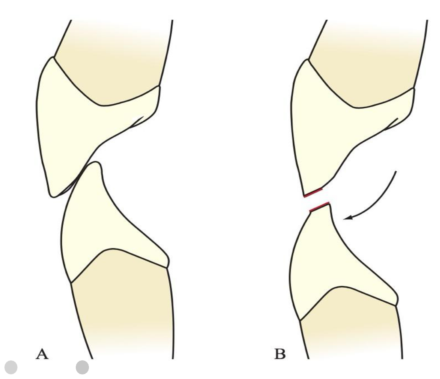 <p>In the lingual surface</p>