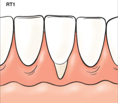 <p>Gingival recession with no loss of interproximal attachment</p>