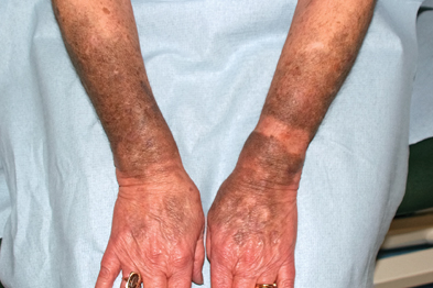 <p>Drug/therapeutic discoloration </p>