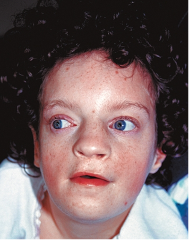 <p>What condition is deletion of 4p?</p>