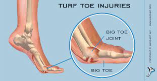 Sprain of the ball of the foot at great toe (joint capsule). Flexor hallucis brevis
