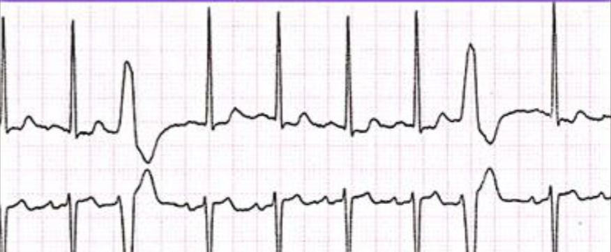 <p>Increased irritability of ventricular cells <br>Early complex followed by a pause </p>