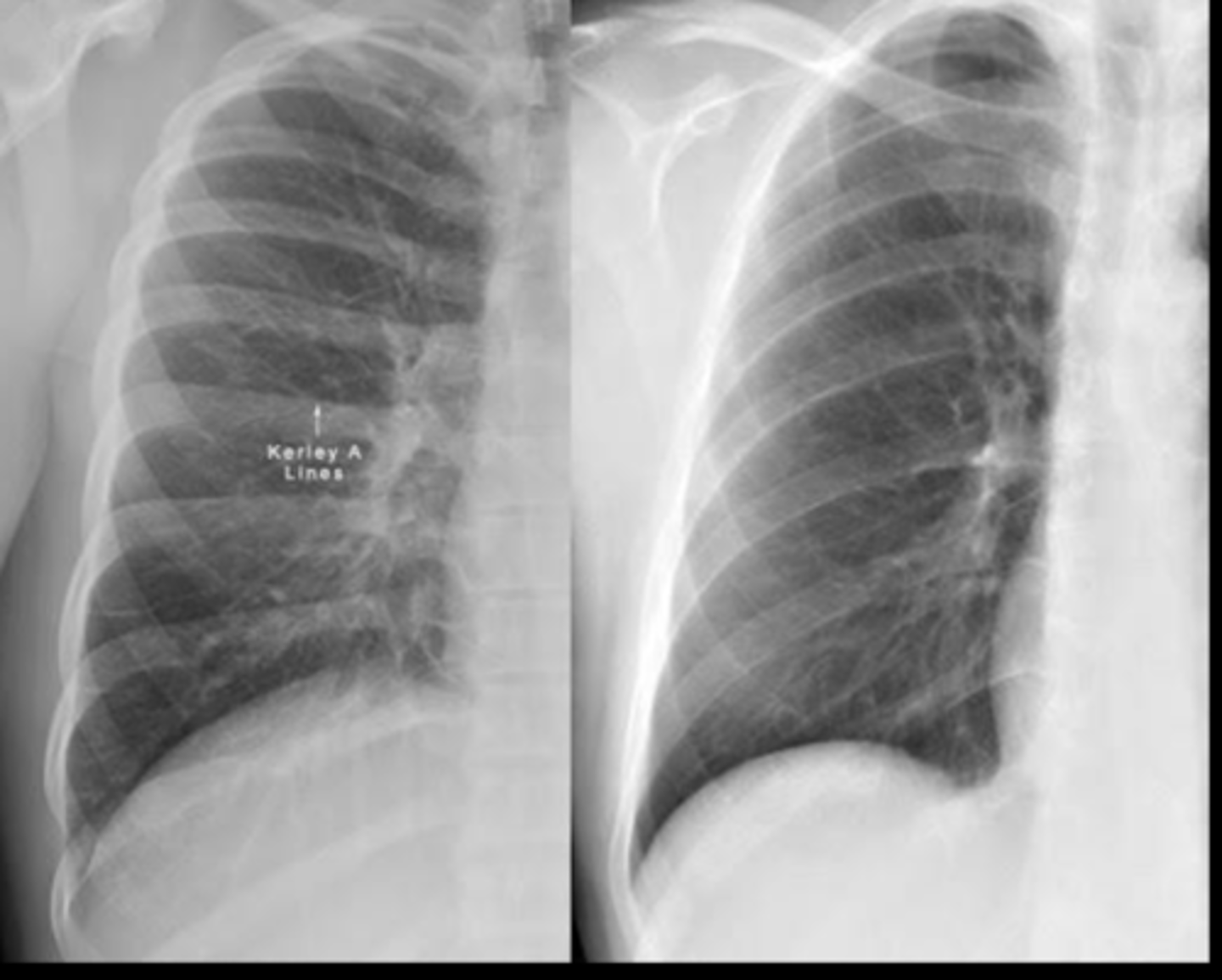 <p>Which side is normal and which is abnormal?</p>
