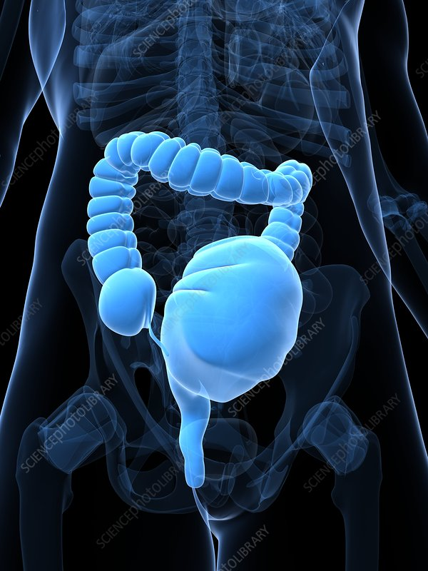 <p>Crohn’s- FISTULA, abscess, obstruction</p><p>UC-TOXIC MEGACOLON, hemorrhage</p><p>(pic is what toxic megacolon looks like)</p>