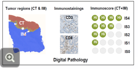 <ul><li><p>combining the knowledge of TILs and the immunological classification of hot and cold tumours has led scientists to develop a new and reliable prognostic biomarker for cancer diagnosis, such as in the case of colon cancer</p></li><li><p>an immunoscore measures the density/numbers of T cells in the centre (CT) and in the periphery (IM) of the tumour by immunochemistry</p></li><li><p>this can help stratify patients as having high risk or low risk cancers, and aid in developing treatment plans</p></li></ul><p>Workflow for determining an immunoscore:</p><ol><li><p>separating the tumour in the central (CT) and peripheral (IM) regions</p></li><li><p>staining for T cells and conducting digital pathology</p></li><li><p>assigning a score to the tumour to relate it with an associated diagnosis or risk attribution</p></li></ol><p></p>
