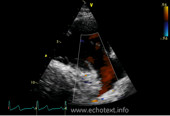 <p>What anatomy is seen in the RVIT view, and what can it evaluate?</p>