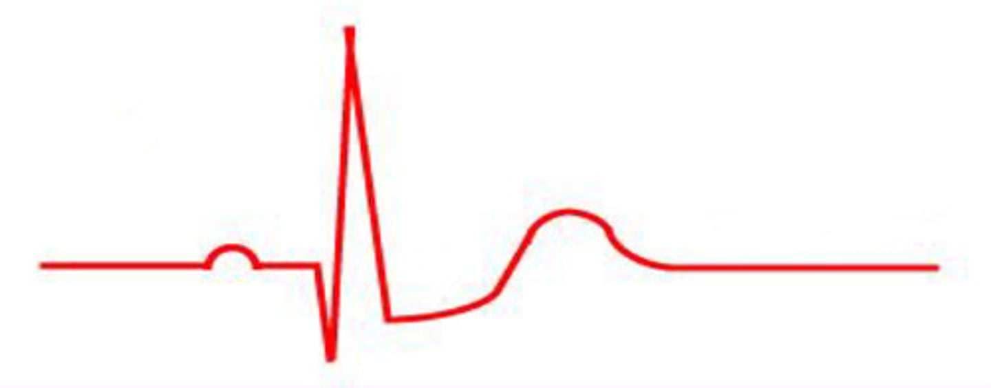 <p>Based on the ST segment, is this showing normal, ST elevation, or ST depression?</p>