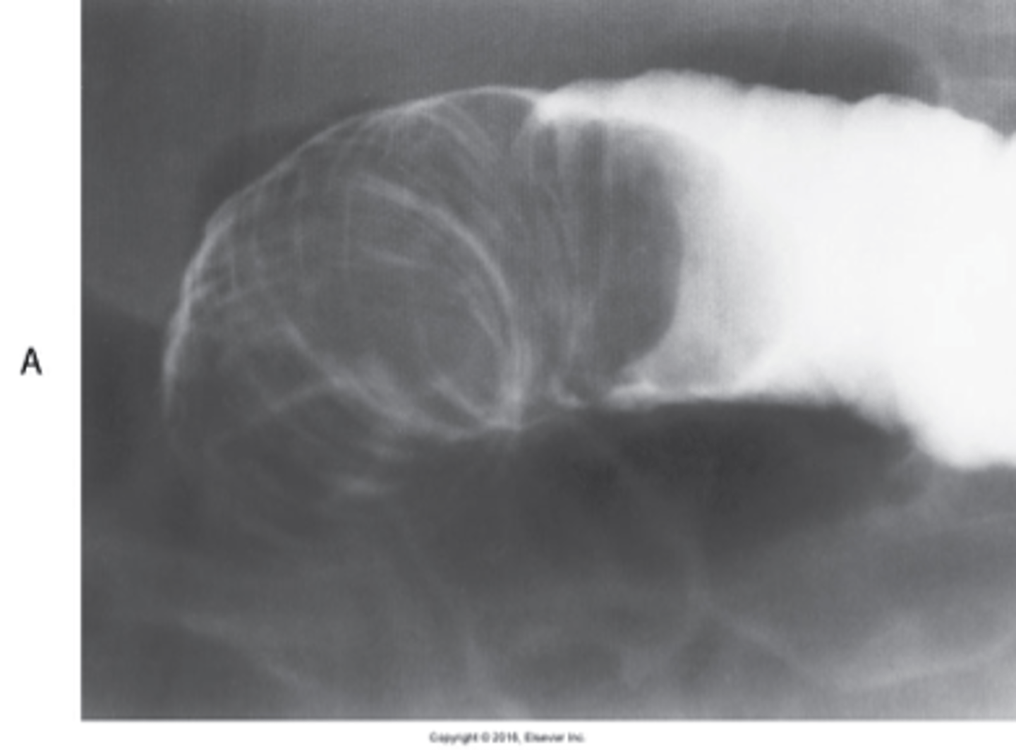 <p>What is intussusception?</p>