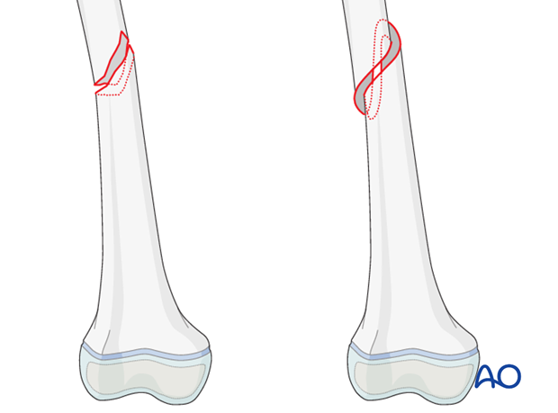 <ul><li><p>fracture caused by twisting motion (IN NAME!!)</p></li><li><p>twisting/corkscrew pattern around bone </p></li></ul><p></p>
