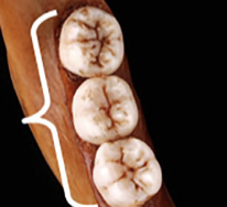 <p>molars </p>