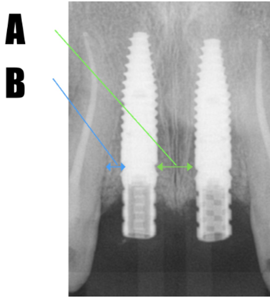 <p>Based on the picture below showing ideal 3D implant position, please select correct answer. (select one)</p><p>A: 2.0mm B: 2.0mm</p><p>A: 2.0mm, B: 1.5mm</p><p>A : 3.0mm B: 1.5mm</p><p>A: 3.0mm B: 2.0mm</p><p>A: 1.5mm B: 3.0mm</p>