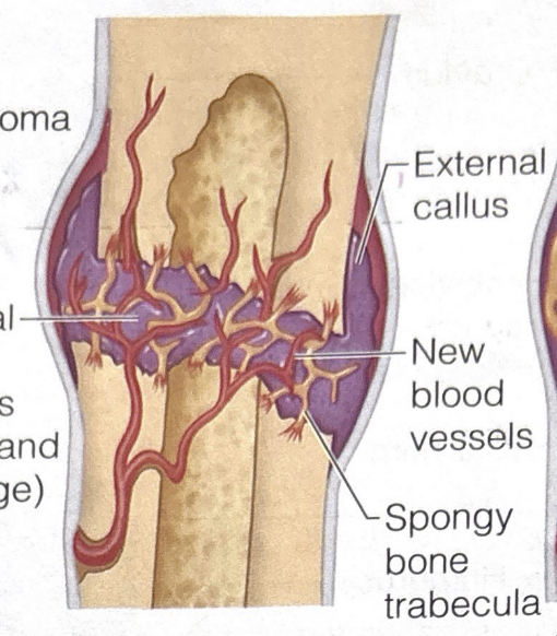 <p>second stage of bone fracture healing</p>