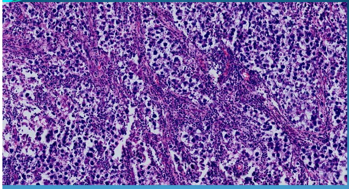 <p>TESTIS:</p><p>Seminoma = Malignant tumor of testicle rising from germ cells, clear cytoplasm + monomorphic, island of tubular cells separated by fibrostroma infiltrated with lymphocytes.</p>