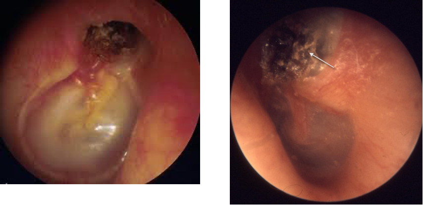 <p>TM drawn inward, sac lined with squamous epithelium</p>