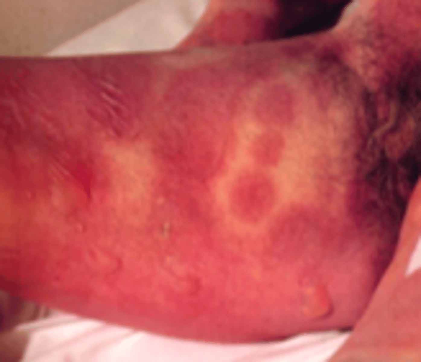 <p>Desquamation Disorders:</p><p>Subjective:</p><p>- Prodrome precedes lesions by 1-3 days</p><p>- High fever</p><p>- Photophobia, conjunctival itching or burning, pain on swallowing</p><p>- Malaise, myalgia, arthralgia</p><p>- Some patients: exanthematous eruption could be heralding sign of this</p>