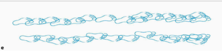 <p>Describe the gait (and its etiology)</p>