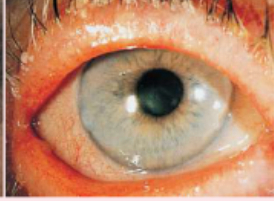 <p>staphylococcal infection of the eyelid</p>