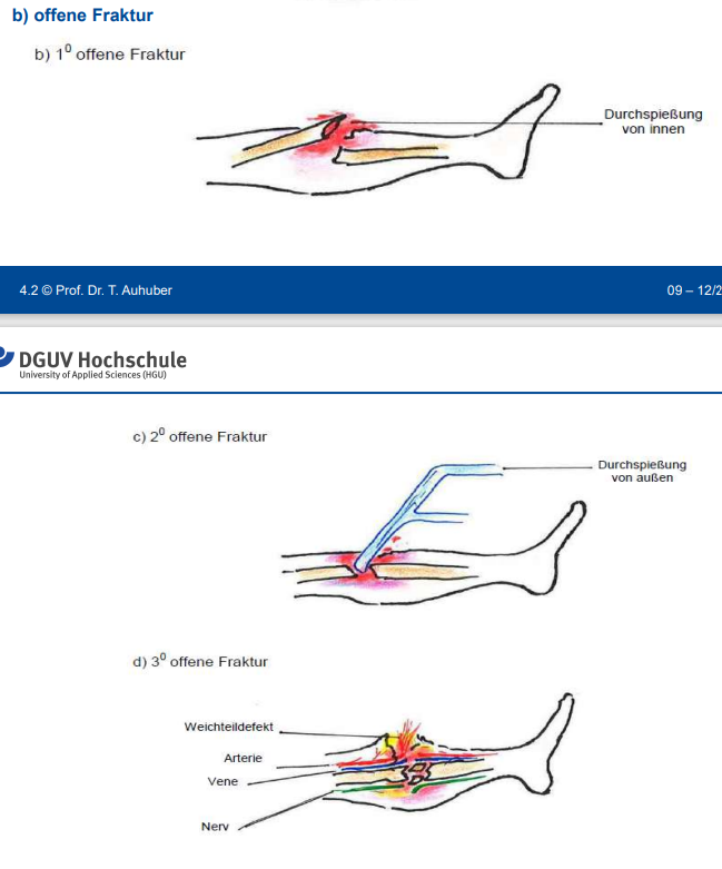 <p>b) kleines Loch, meist weniger kompliziert</p><p>c) von außen kommend, größere Weichteilschäden, komplexer</p><p>d) Aterie, Wehne, Nerv auch betroffen, komplizierter</p>