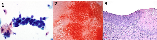 <p>what causes cervical cancer?</p>