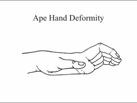 <p>-Wasting of thenar eminence d/t median nerve palsy</p><p>-Thumb falls back in line with fingers d/t pull of extensor muscles</p><p>-Pt unable to flex or oppose thumb</p>