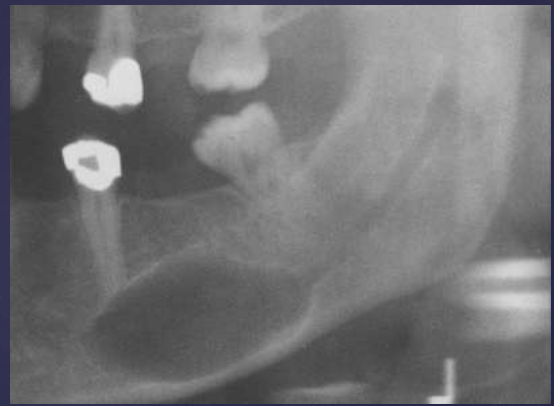 <ol><li><p>radiolucent</p></li><li><p>unilocular/multilocular</p></li><li><p><strong>fusiform enlargement</strong> of the neurovascular canal</p></li></ol><p></p>