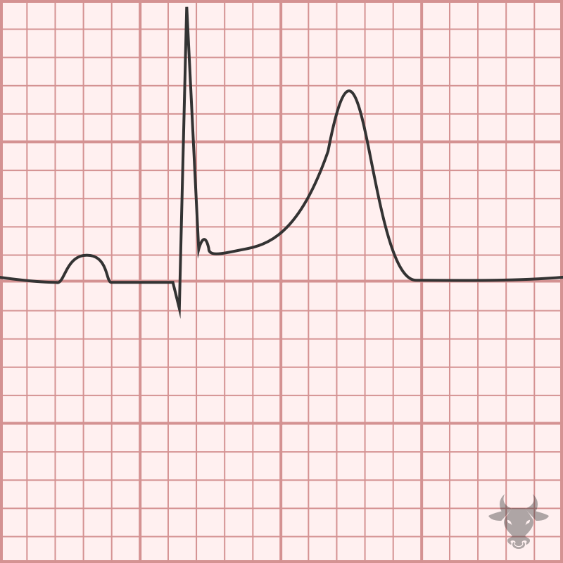 <p>Normal variant of ST changes</p>