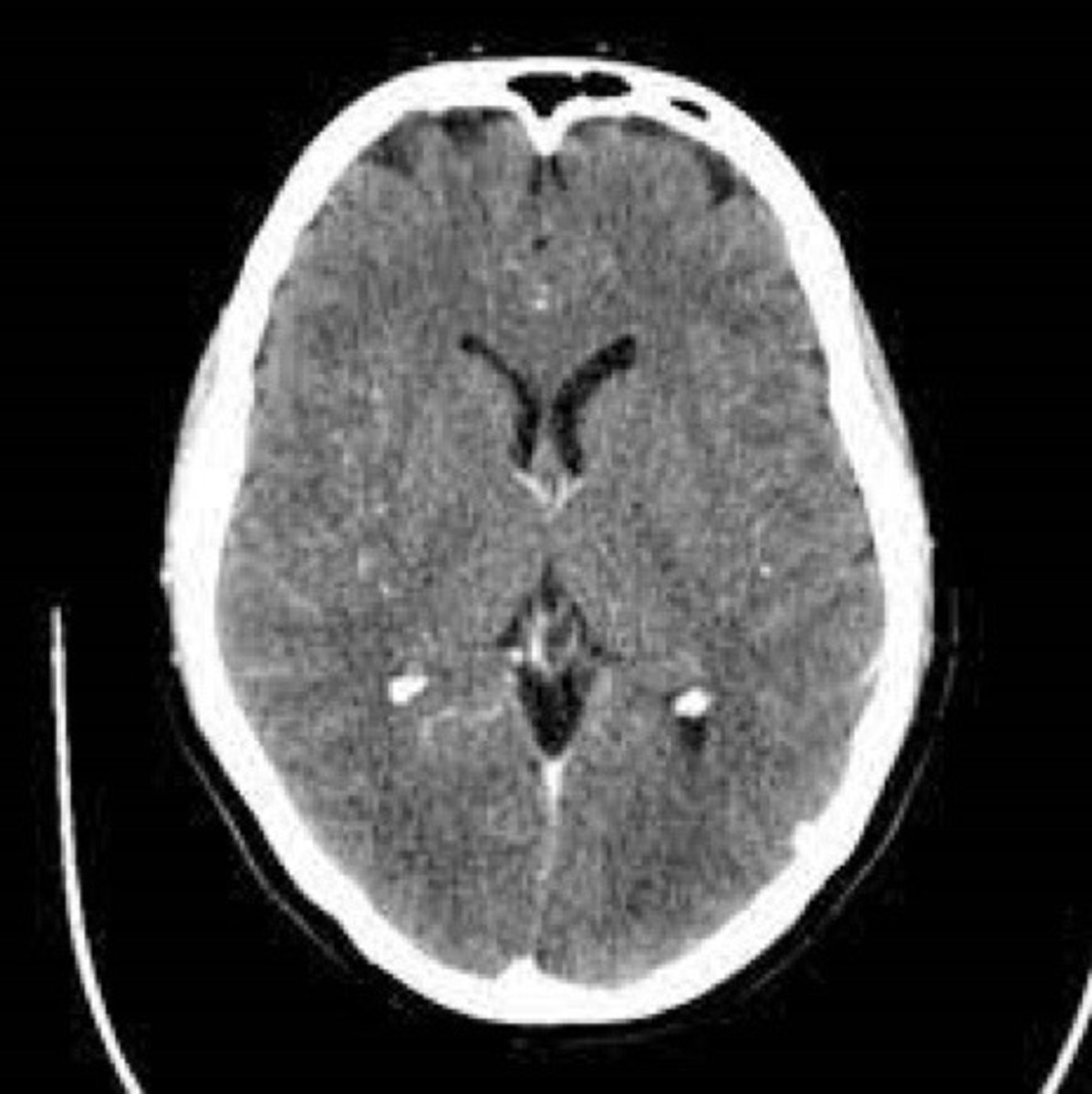 <p>In which anatomical plane is this CT scan of the head taken</p><p>Saggital, coronal, transverse?</p>