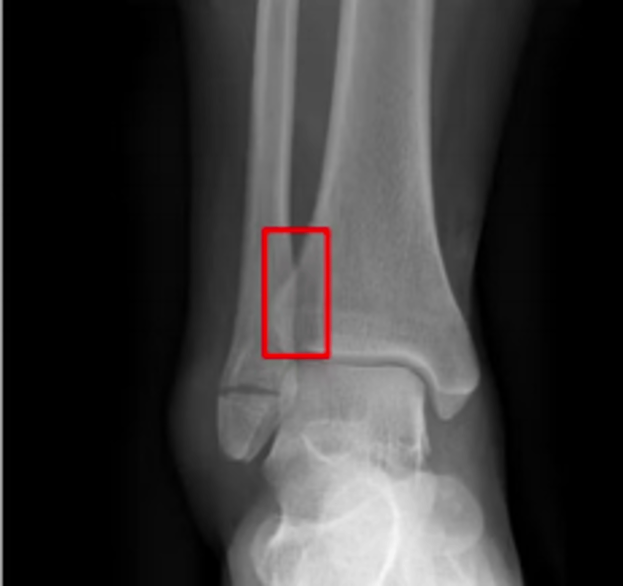 <p>According to the Danis-Webber classification - what type of ankle fracture does this x-ray show?</p>