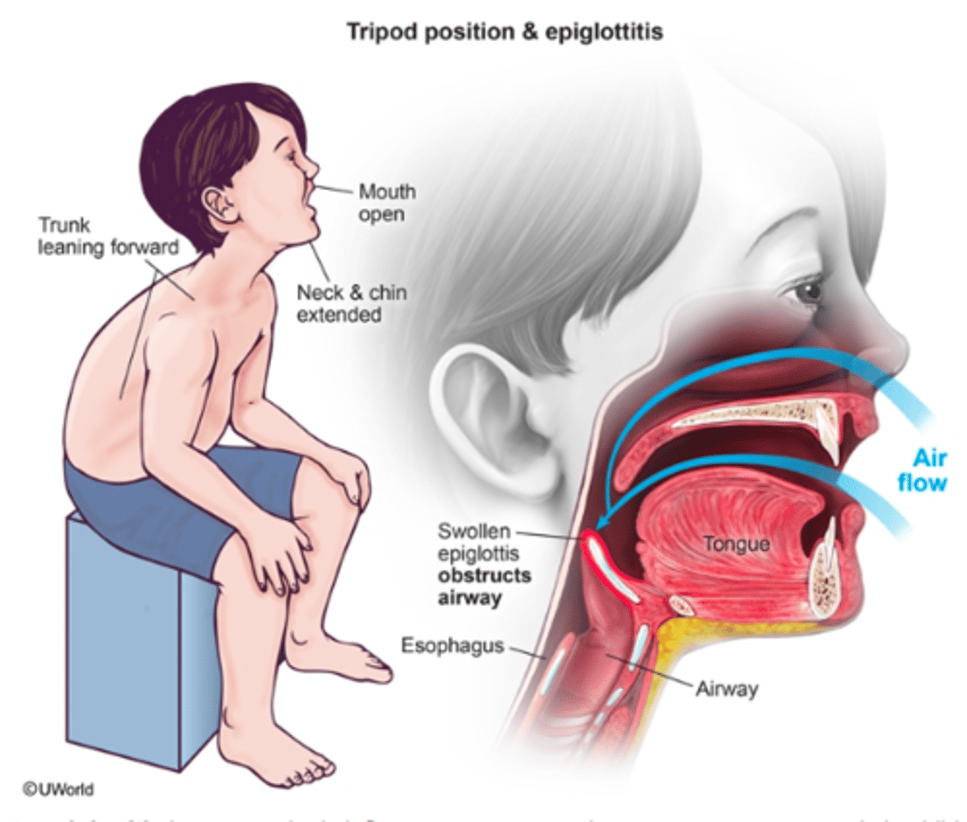 <p>-drooling (cannot tolerate oral secretions aka cant swallow)</p><p>-odd sitting forward position (trunk leaning forward)</p><p>-inspiratory stridor</p><p>-respiratory distress</p><p>-central cyanosis</p><p>-pallor</p>