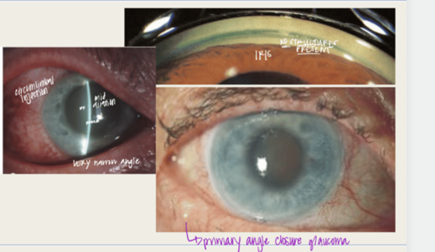 <p>What are the complications of acute angle closure crisis?</p>