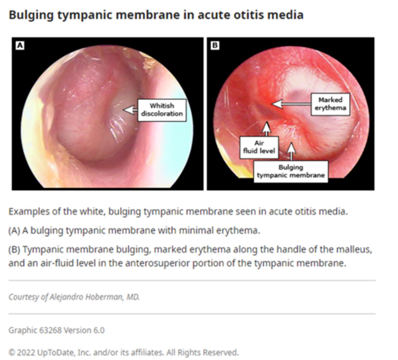 <p>Bulging tympanic membrane<br><br>Fluid-filled middle ear (effusion)<br><br>Decreased TM mobility on pneumatic otoscopy<br><br>Perforation of the TM with purulent discharge</p>