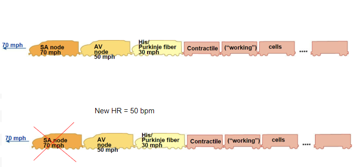 <p>AV node goes 50. AV node takes over, new bpm is 50.</p><p>Heart still works but is slower</p>