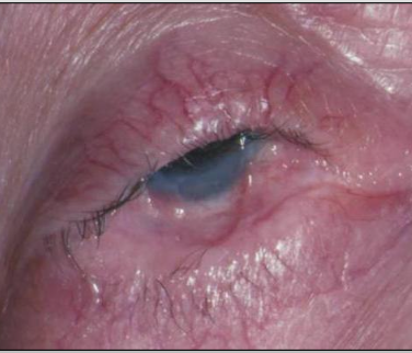<p>Symblepharons (fibrous scars) along the eye</p>