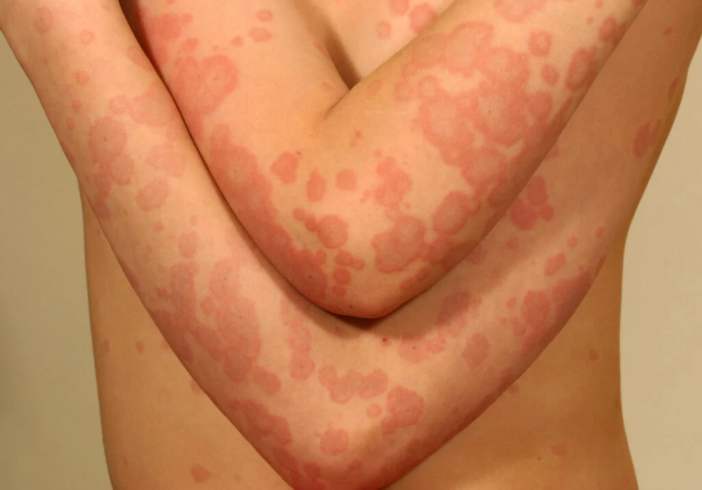 <p>redness</p><ul><li><p>body’s response to irritation due to heat, abrasions, infections, etc</p></li></ul><p></p>