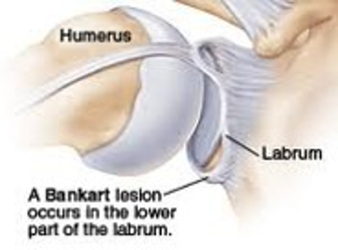 <p>part of labrum tears during anterior dislocation of shoulder</p>