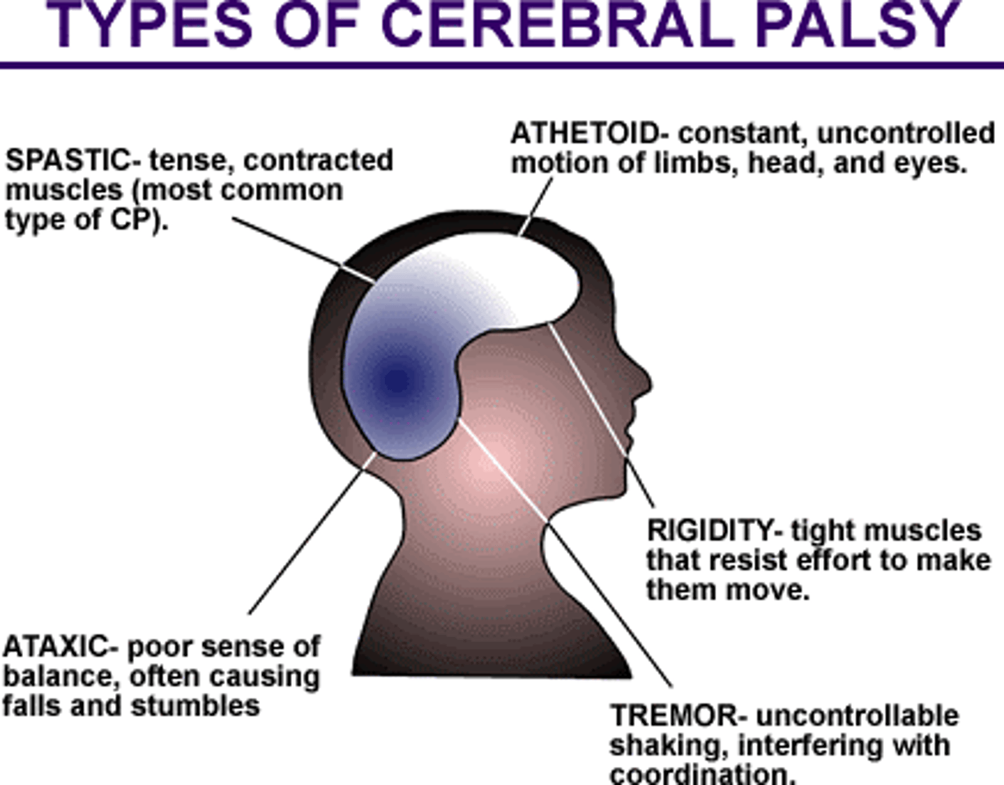 <p>Umbrella term used to describe a group of non-progressive movement disorders that result from brain damage.</p><p>Clinical presentation includes motor delays, abnormal muscle tone and motor control, reflex abnormalities, poor postural control, and balance impairments.</p>