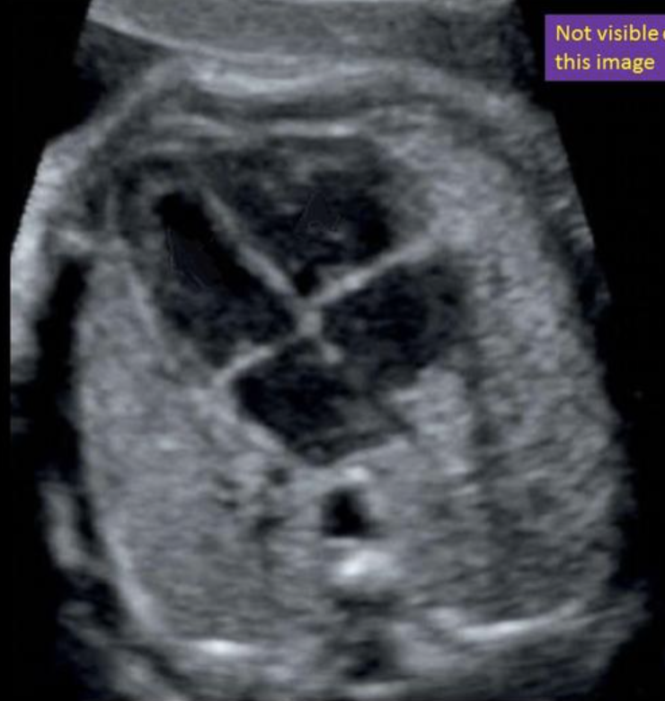 <p>where is the right ventricle </p><p>a) top left</p><p>b) top right</p><p>c) bottom left</p><p>d) bottom right</p>