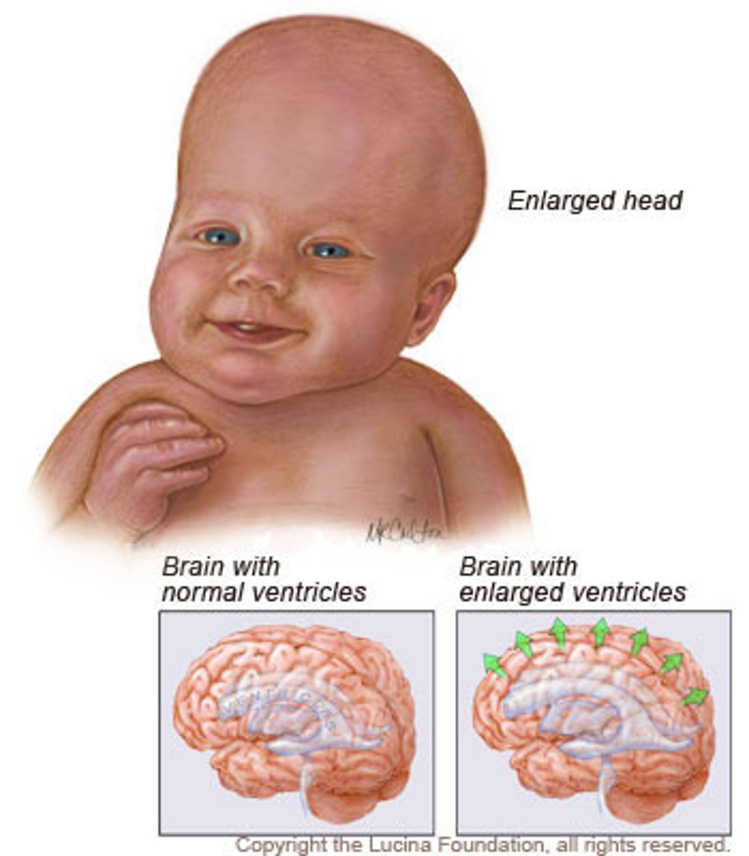 <p>water on the brain</p>